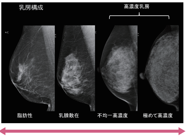 乳房構成